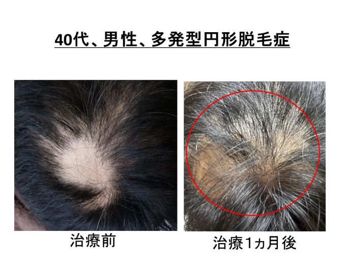 円形脱毛症　病院